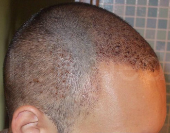 Alopecie