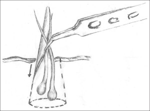 extraction_by_expanding_needle_concept