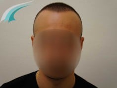 Résultat greffe de cheveux Dr Beyhan Istanbul