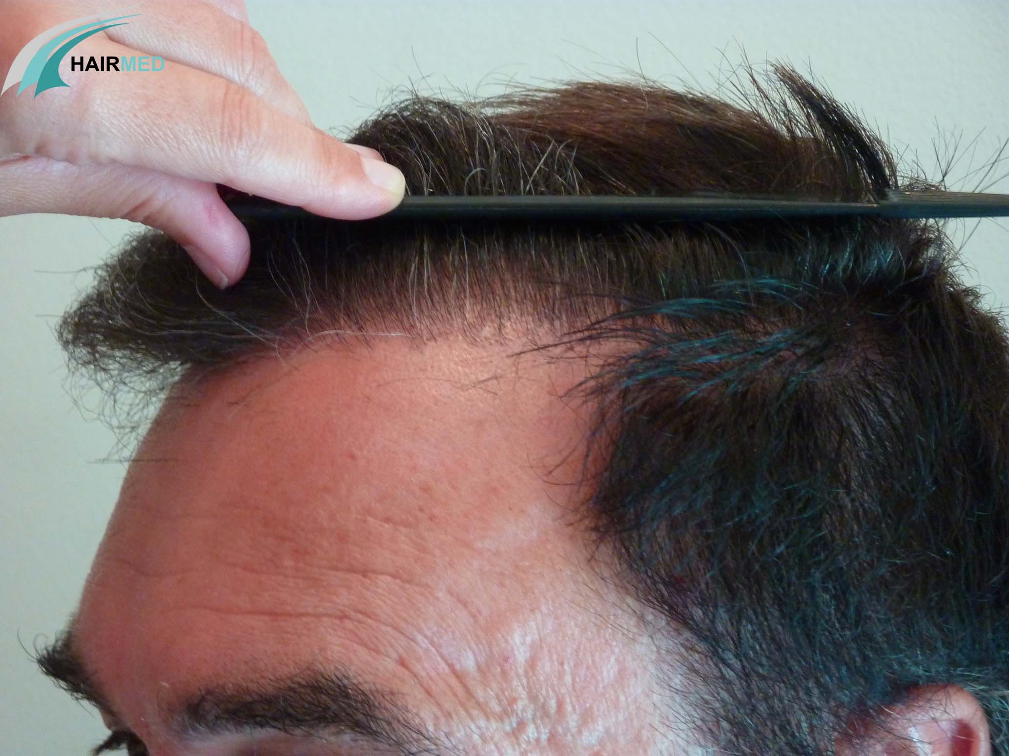 Ligne frontale après une greffe de cheveux - Greffe-cheveux