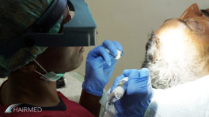Dermopigmentation SMP - Scalp MicroPigmentation
