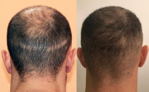 tricopogmentation - cacher cicatrice