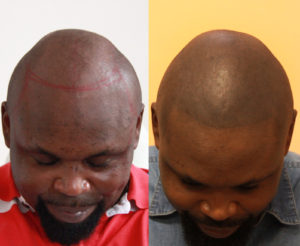 tricopigmentation